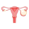 Ovarian Cysts Diagnosis & Removal