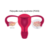 PCOS Treatment